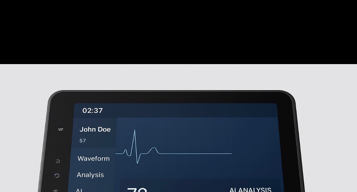 Clinical Case Report: Longitudinal MCG (Premier Heart's Multifunction Cardiogram Test) Analysis of Myocardial Dysfunction in a 55-Year-Old Male with poorly controlled hypertension