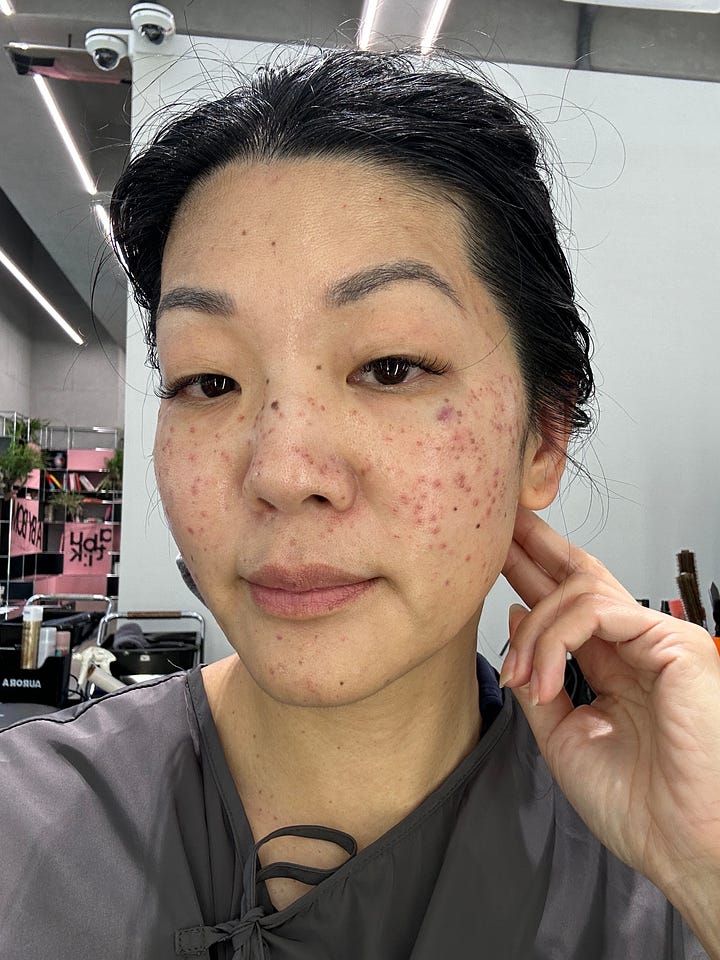 Michelle Lee after Korean skin clinic
