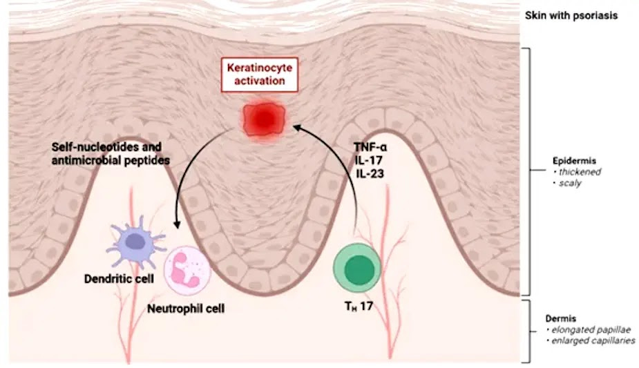 illustration of the pathomechanism of psoriasis.