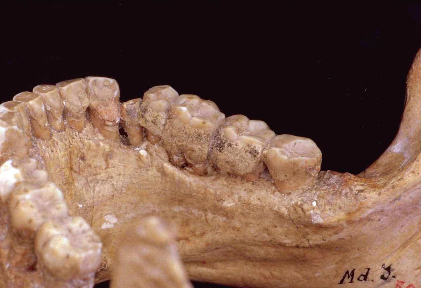 A Neanderthal jaw with teeth encrusted with calculus A Neanderthal jaw with teeth encrusted with calculus