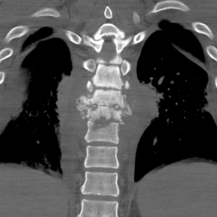 Discitis Ct Scan Vertebral osteomyelitis/discitis - by Alexander Baxter