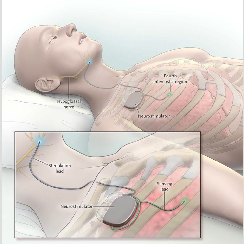 Inspire Patient Guide.pdf Surgeon's Guide: Inspire