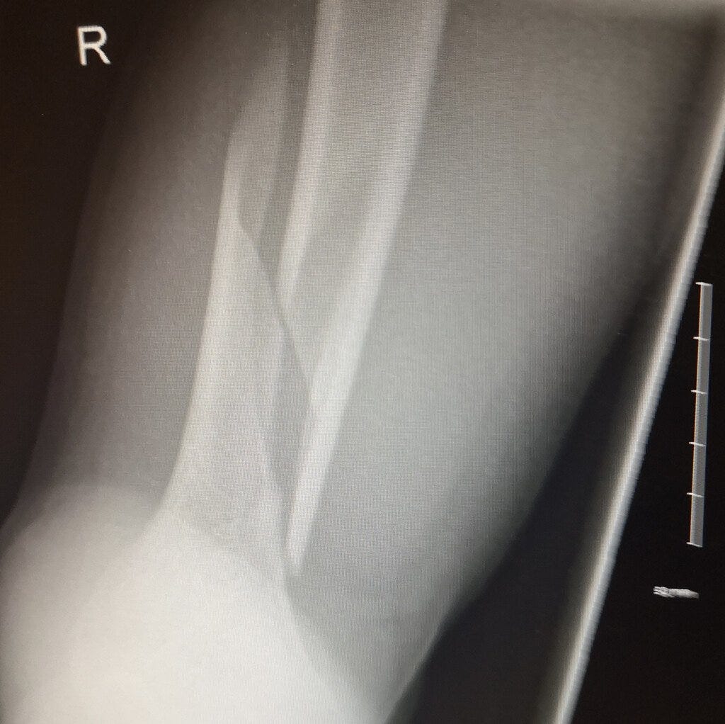 X-ray image showing a fractured right leg bone with a visible break and misalignment of the bone fragments.