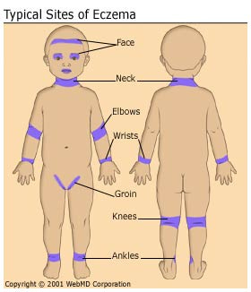 Typical sites of Eczema