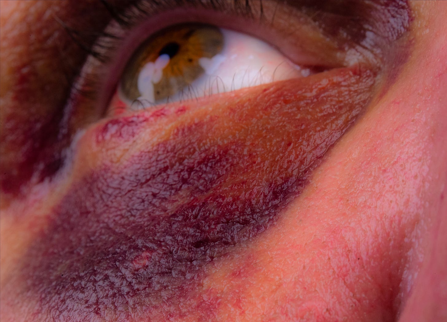 A human eye, blackened, ostensibly from a punch