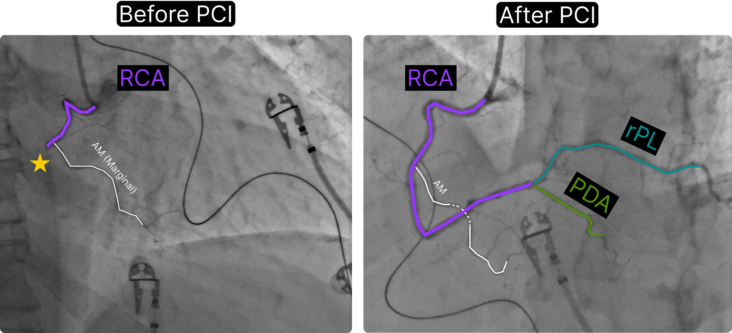 Mid RCA Culprit Before and After PCI showing restoration of blood flow to distal RCA including RPL and PDA.