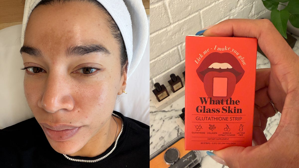glutathione mesotherapy for melasma Melasma (and microneedling), 15 months later