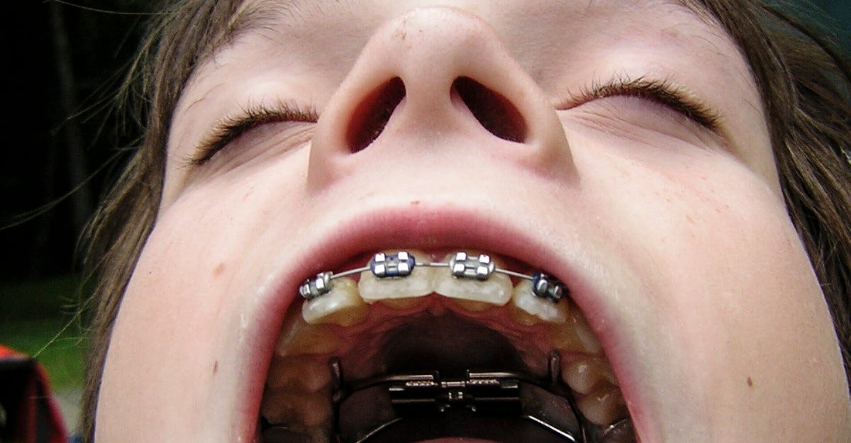 The History of Braces: An Object Lesson - The Atlantic