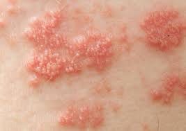 New Shingles Vaccine Shingrix Much More ...