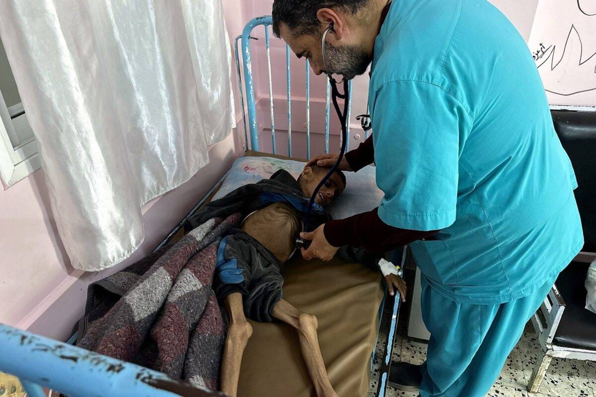 A Palestinian child named Osama El Rakab struggles for his life at Nasser Hospital in Khan Yunis, located in the southern part of Gaza, due to malnutrition-related body weakness on April 24, 2025 [Doaa Albaz/Anadolu Agency]