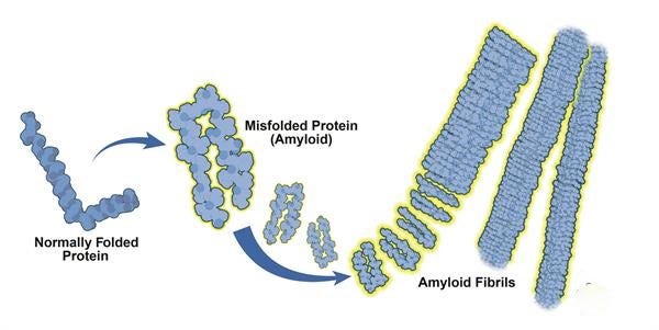 Dialysis Related Amyloidosis - Beta 2 Amyloidosis in CKD - Home ...