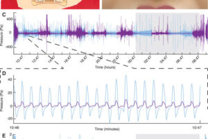 Figure 1 Logging nasal airflow over extended periods of time