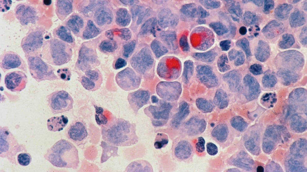 CLL is Chronic Lymphatic Leukemia. 