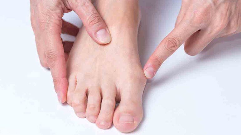 bunion gait retraining bunion gait retraining