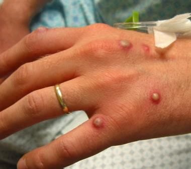 Monkeypox (Mpox): Practice Essentials, Pathophysiology, Etiology