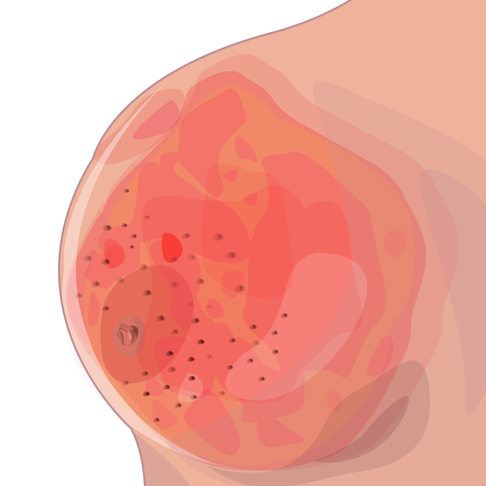 File:Peau d orange inflamatory breast cancer svg hariadhi.svg