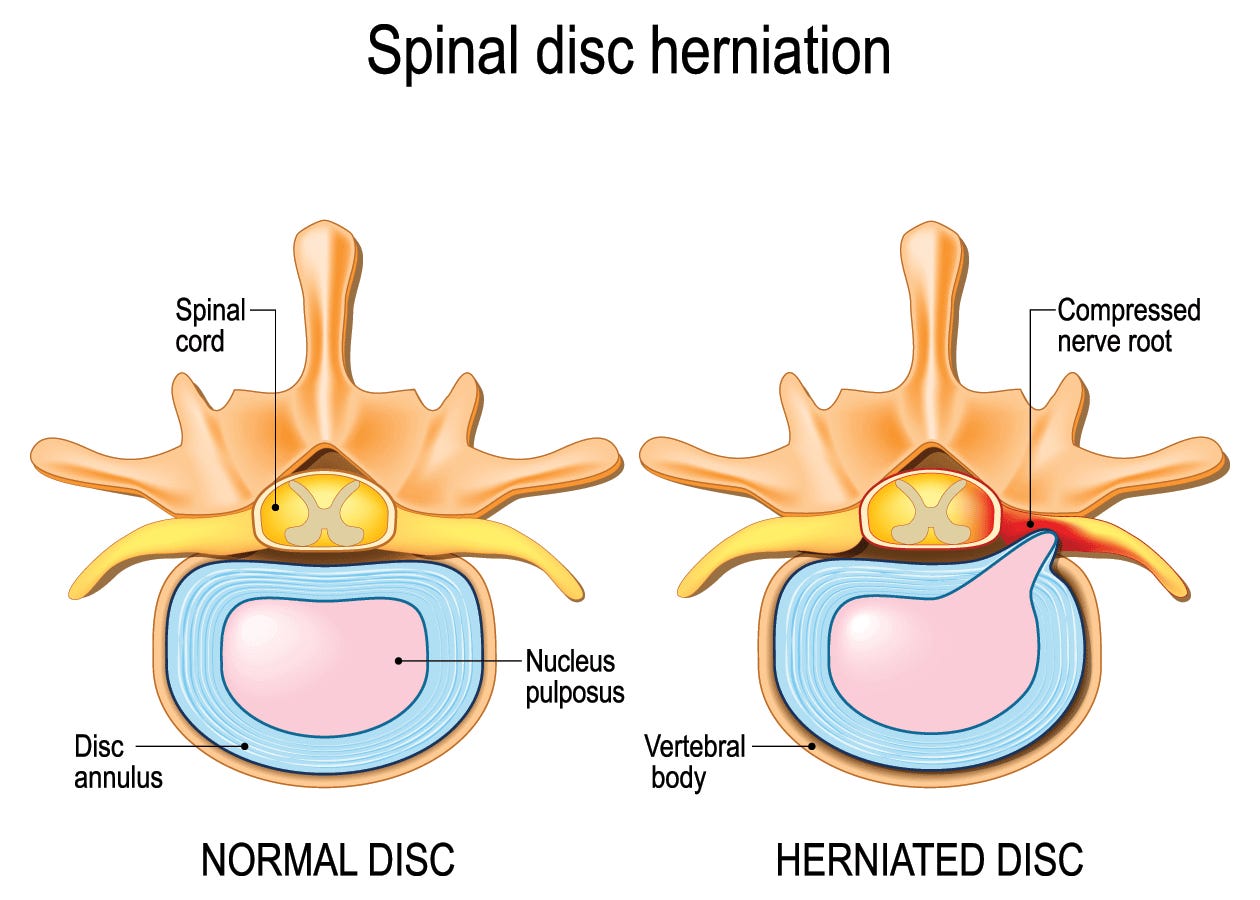 Spinal disc herniation diagram - Sam LaPorta Detroit Lions Spinal disc herniation diagram - Sam LaPorta Detroit Lions