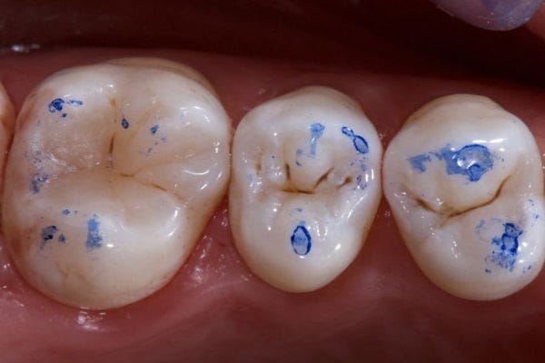 Dental Articulating Paper | Henry Schein Dental