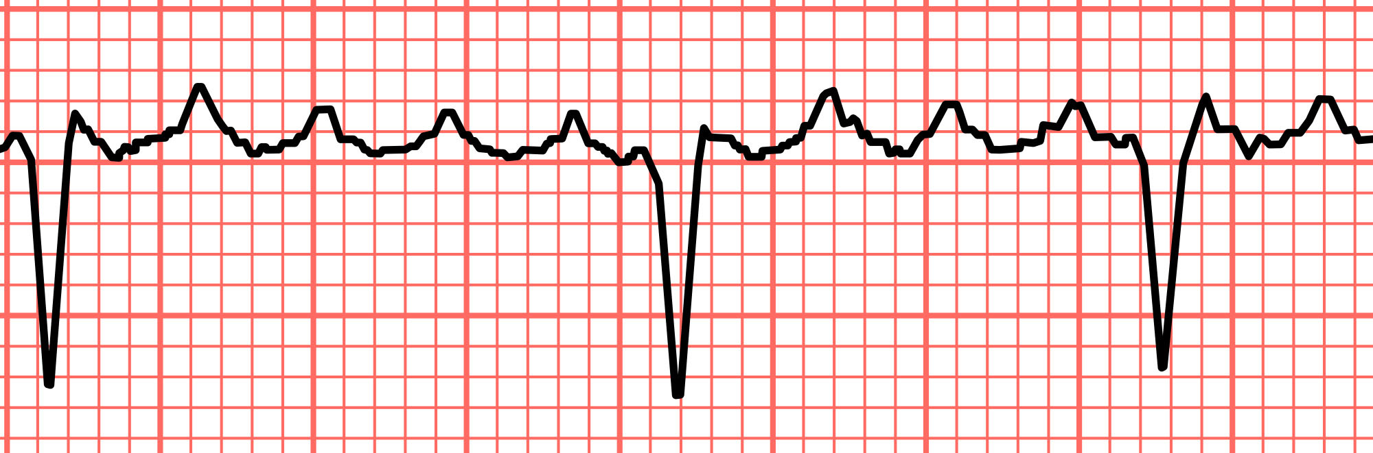 Seven differences between atrial fibrillation and atrial flutter