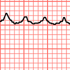 Seven differences between atrial fibrillation and atrial flutter