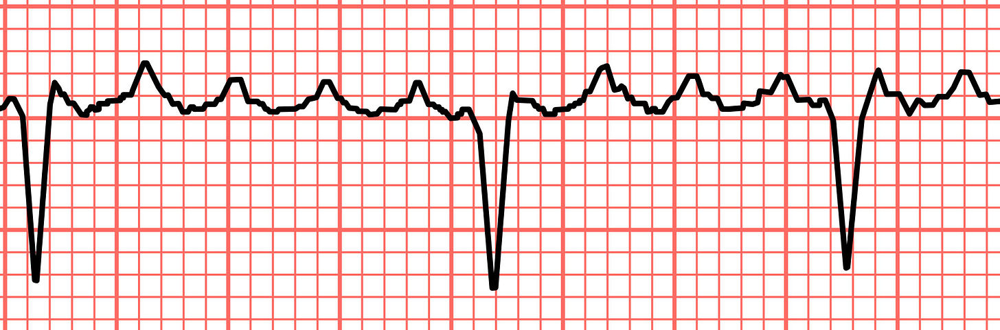 Atrial flutter sawtooth pattern Atrial flutter sawtooth pattern