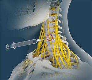Stellate Ganglion Block Newport Beach, CA | Nerve Injury Newport Beach, CA