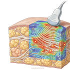 New Study Reveals a Measurable Link Between Tissue Stiffness and Pain in Lipedema