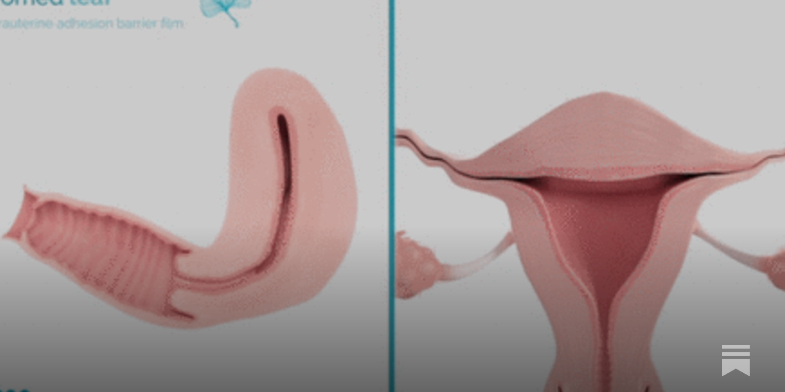 FDA approves Womed's first device for Asherman syndrome offering new hope in reproductive surgery