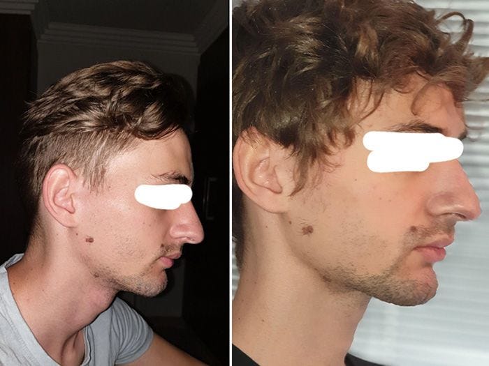 70+ Mewing Before and After: 4 Months of Mewing Transformation Results