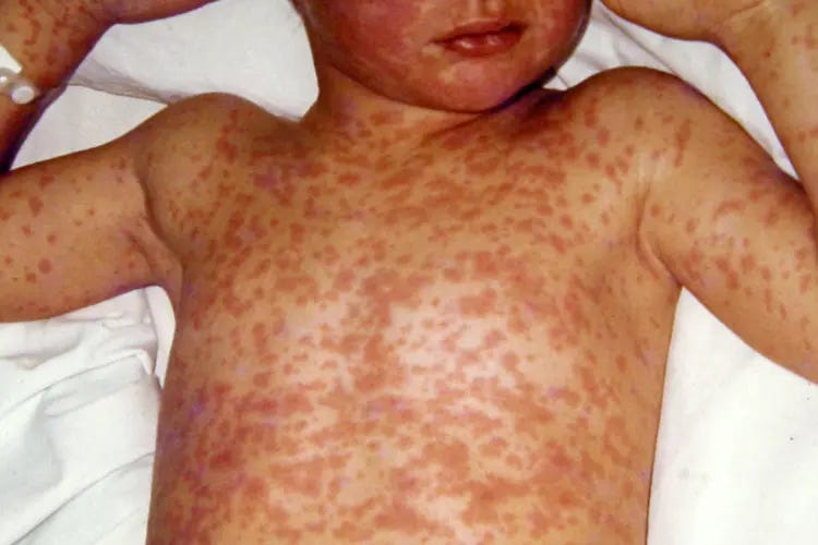 Measles Virus (Rubeola): Symptoms, Causes, Treatment