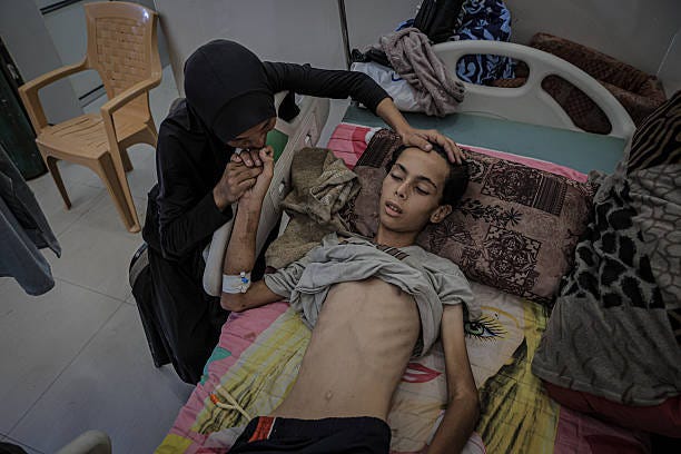Palestinian teenager Atif Aid Abu Khater, weighing only 25 kilograms due to malnutrition, is receiving treatment under limited conditions at Al-Shifa...