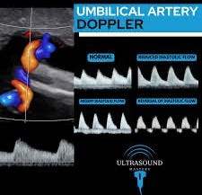 💡When should a Doppler study of the umbilical artery be performed? The  main indications include: ▶️Suspected fetal growth restriction (FGR):  Identified by low estimated fetal weight, abdominal circumference, or  inadequate fetal growth.