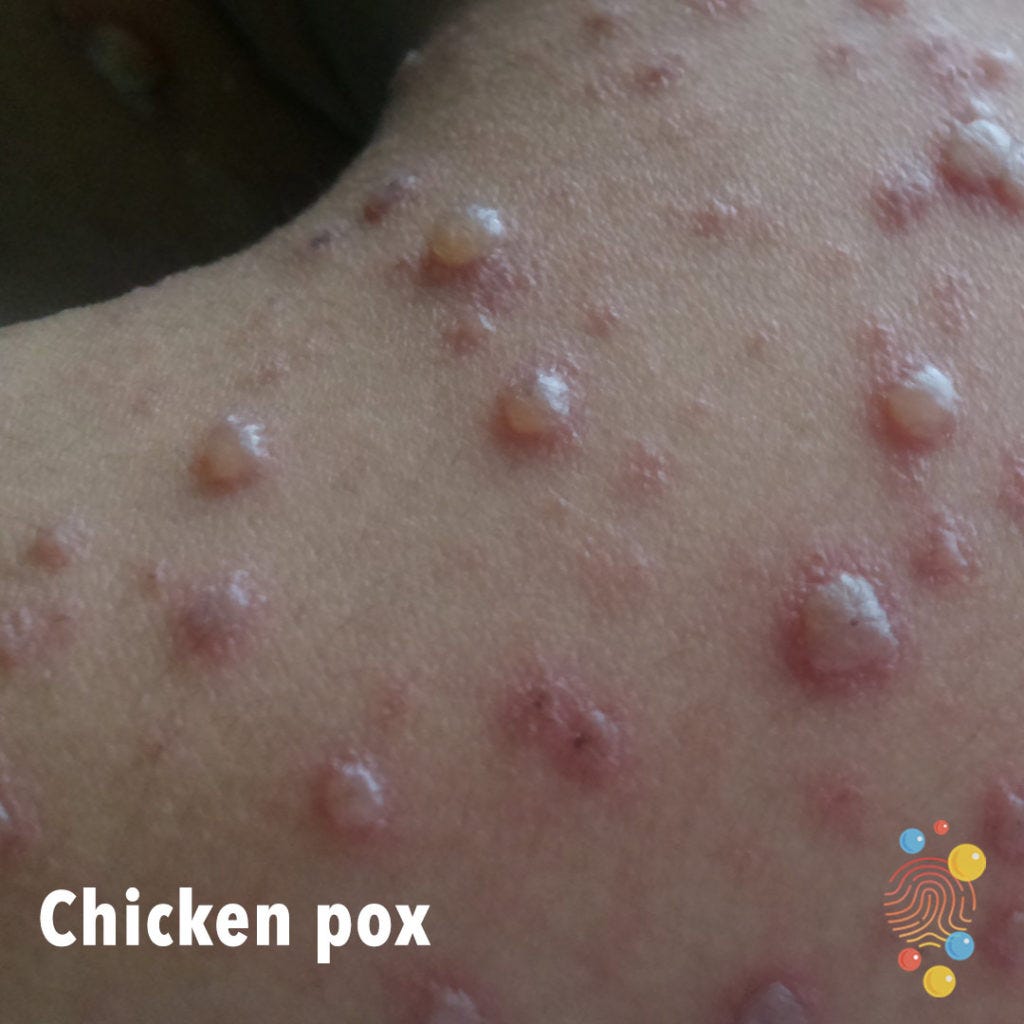 https://dftbskindeep.com/wp-content/uploads/2020/08/OD7-chicken-pox-1024x1024.jpg
