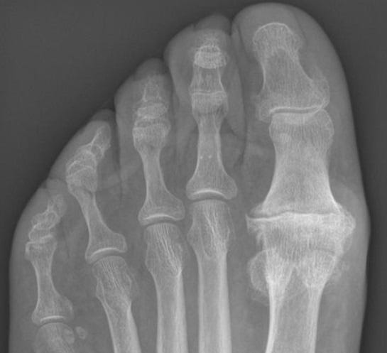 hallux rigidus.