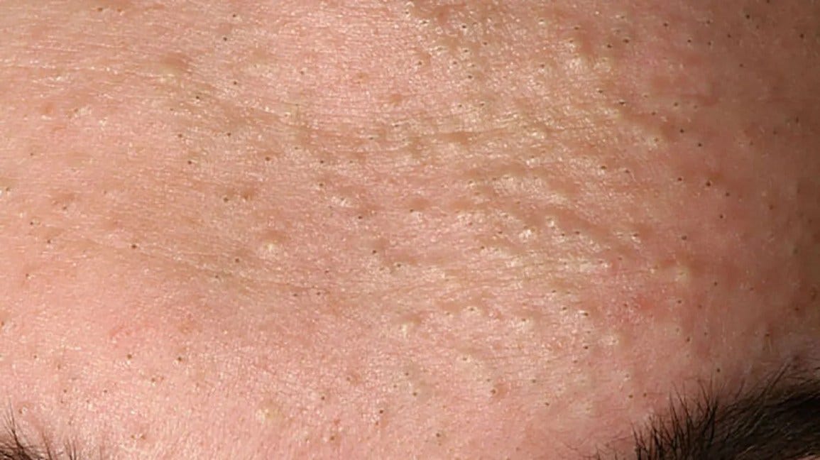 Comedonal acne: Pictures, treatment, and remedies