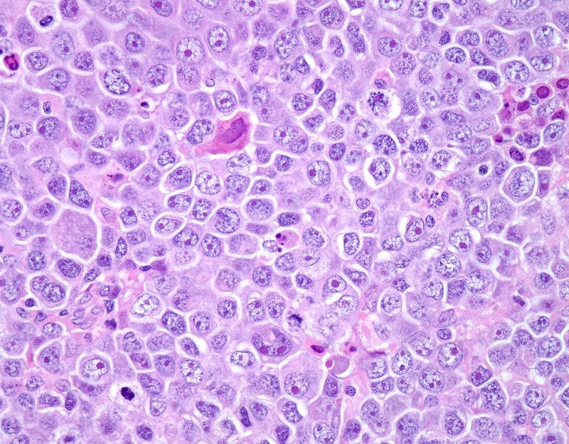 Diffuse large B-cell lymphoma, light micrograph Diffuse large B-cell lymphoma, light micrograph