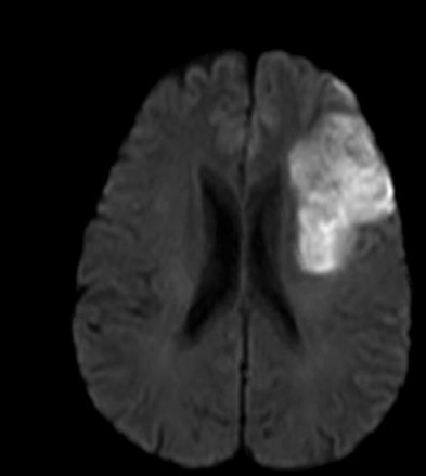 TC de AVC hemorrágico (Fonte: Radiopaedia)TC de AVC hemorrágico (Fonte: Radiopaedia)