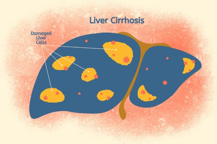 Liver Cirrhosis