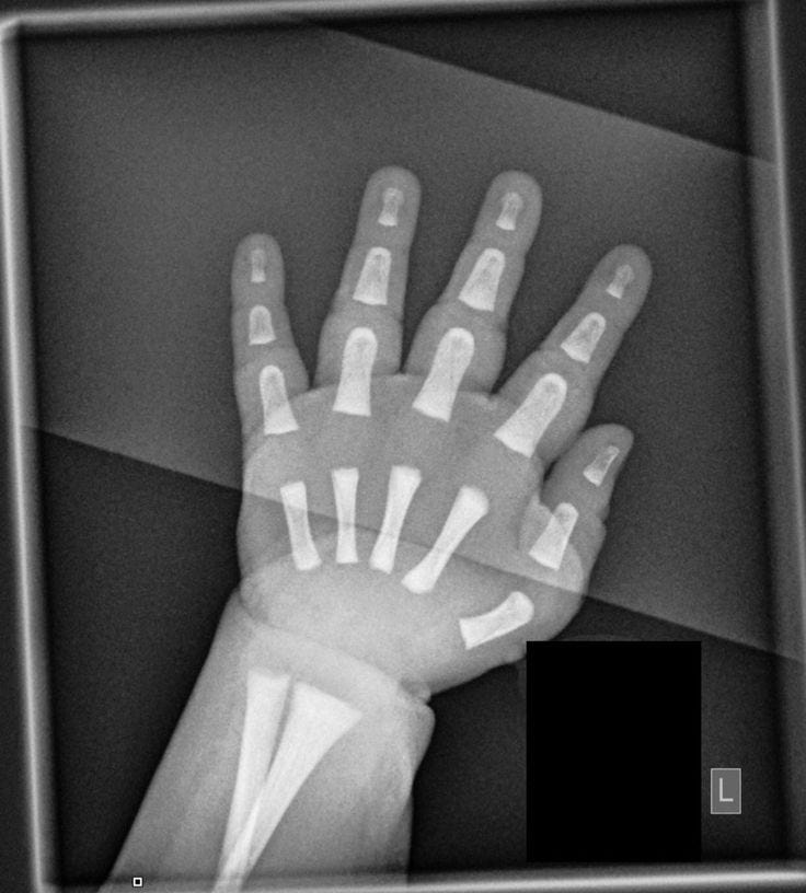 This may contain: a black and white photo of a hand with bones on it's palm in front of a square frame This may contain: a black and white photo of a hand with bones on it's palm in front of a square frame