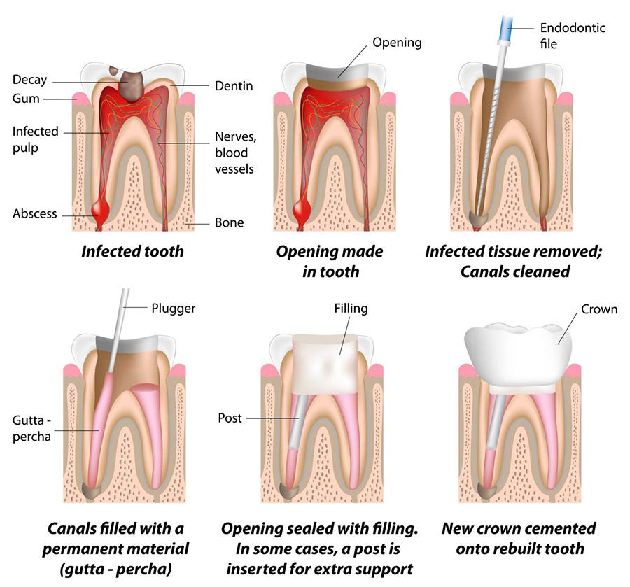 Root canal treatment | healthdirect