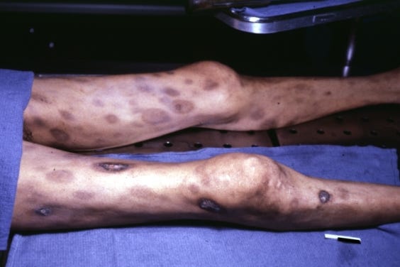 AN advanced case of disseminated intravascular coagulopathy. AN advanced case of disseminated intravascular coagulopathy.