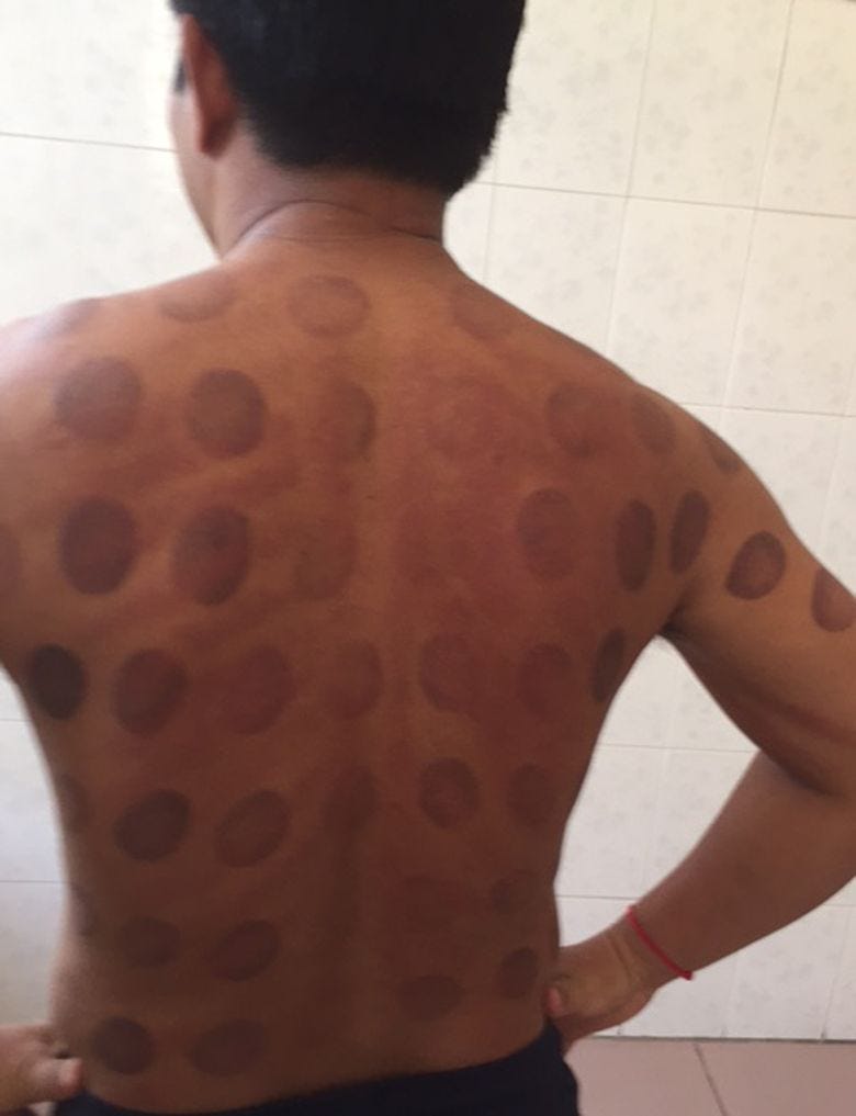 Cupping and coining: I did it long before Phelps | The Seattle Times