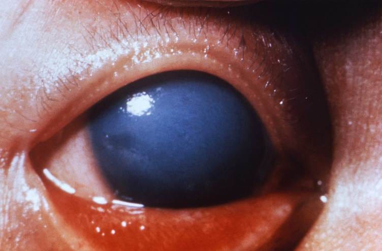 A close-up photo of a child’s eye being held open. A white film covers the entire iris so that the pupil cannot be seen. A close-up photo of a child’s eye being held open. A white film covers the entire iris so that the pupil cannot be seen.