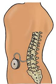 Intrathecal Baclofen