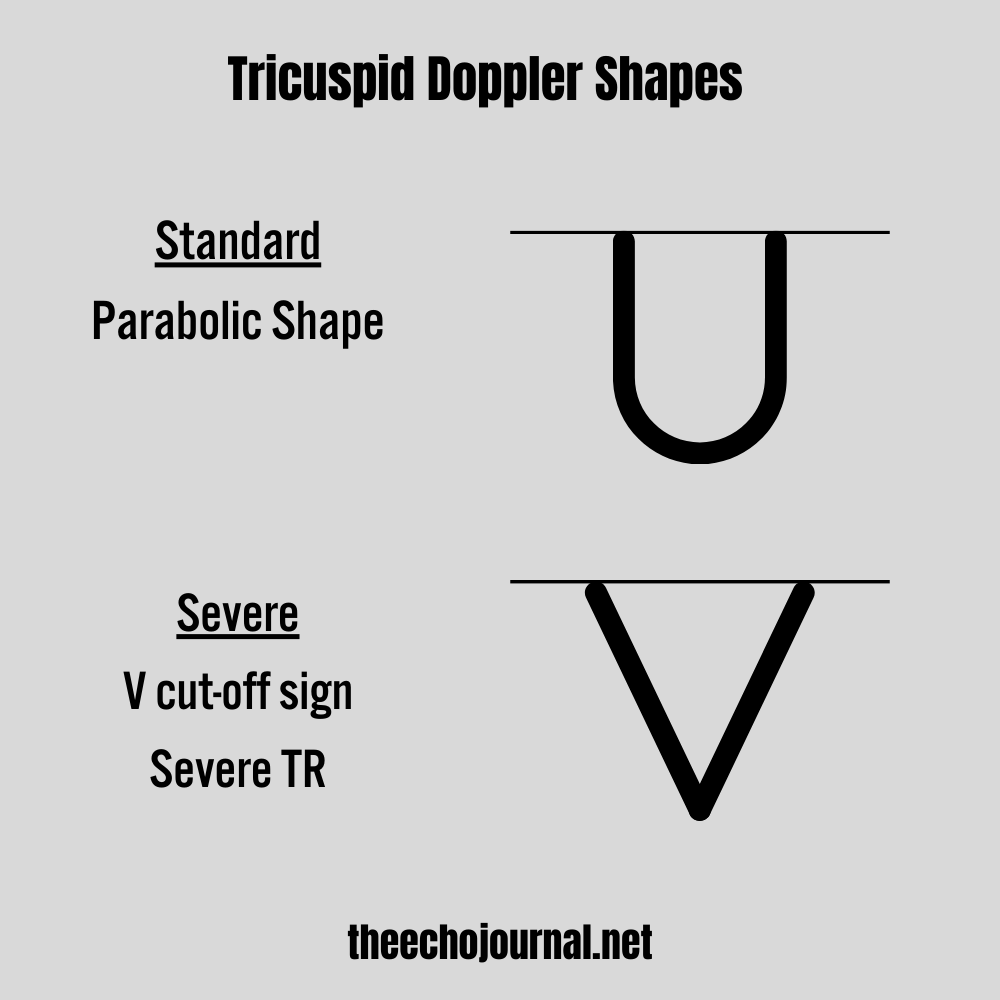 The Secrets About Tricuspid Regurgitation - by Aram K.
