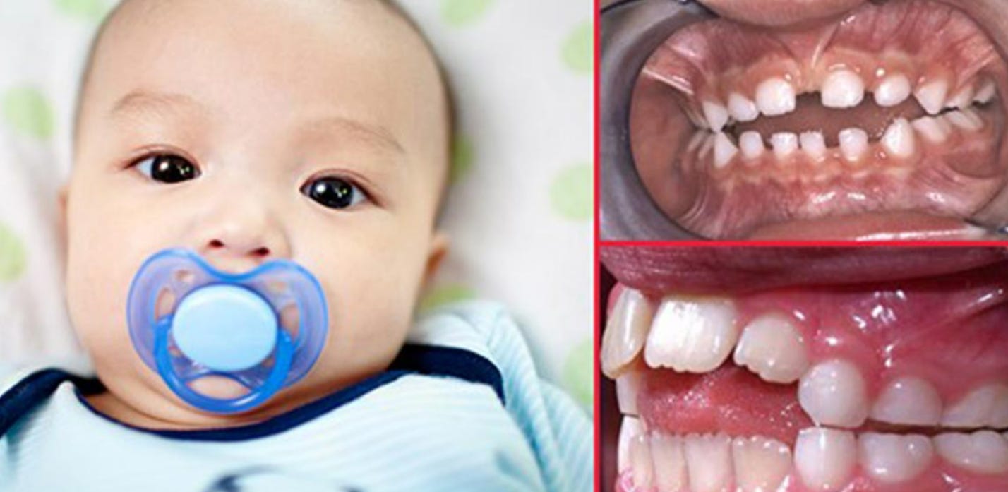 Buy pacifier use and teeth Online