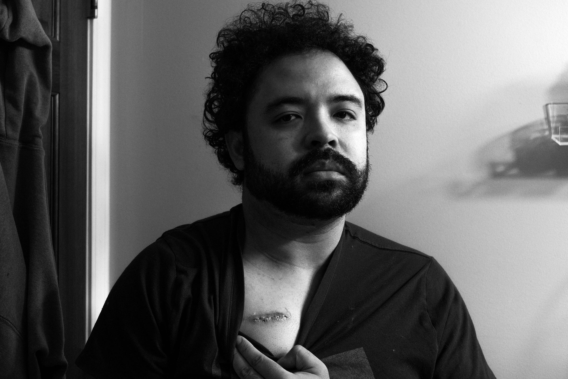 Black and White photo of the author staring into the camera with heavy eyes showing scar on chest.