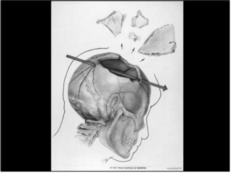 A Review of the JFK Cranial x-Rays and Photographs 13 - Assassination ...