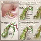 Acute Cholecystitis - Nice Review of Pathophysiology and Clinical Approach