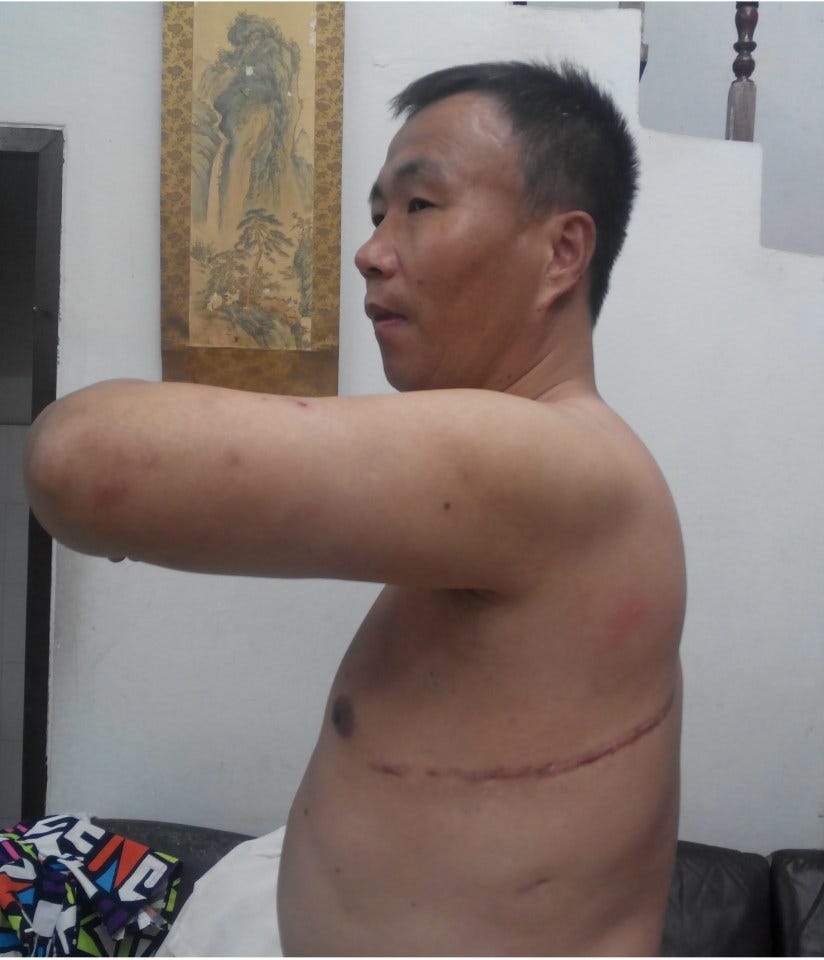 Man's torso showing surgical scars. Man's torso showing surgical scars.
